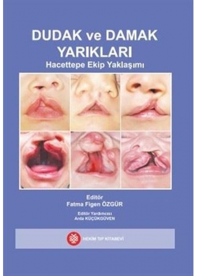 Dudak ve Damak Yarıkları