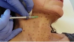 Sito Botulinum Toksin Video 2.5