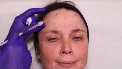 Sito Botulinum Toksin Video 3.1
