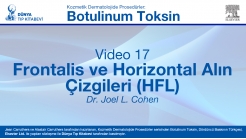 Video 17: Frontalis ve Horizontal Alın Çizgileri (HFL)