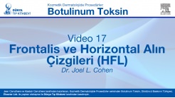 Video 17: Frontalis ve Horizontal Alın Çizgileri (HFL)