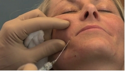 Nazolabial Oluk KDHA