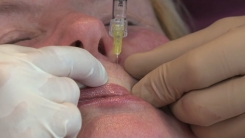 Radial Çizgiler-Gerdirme