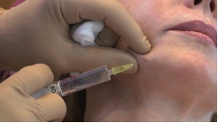 Marionette Çizgileri KDHA 2