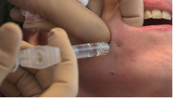 Marionette Çizgileri VSDT