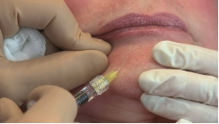 Çene Yüzeyel Enjeksiyonlar