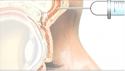 Direkt Enjeksiyon Teknikleri