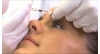 Subdermal Kabartı Tekniği