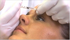 Subdermal Kabartı Tekniği