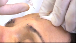 Enjeksiyonu Planlama ve İşaretleme