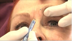 Horizontal Alın Çizgilerinin Tedavisi