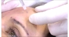 Glabella Çizgilerinin Tedavisi