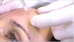 Glabella Çizgilerinin Tedavisi