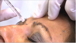 Kimyasal Kaş Kaldırma