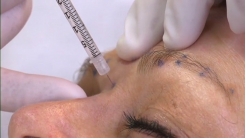 Yüzün Üst Üçte Birlik Kısmı-Olgu 4