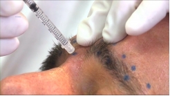 Yüzün Üst Üçte Birlik Kısmı-Olgu 5