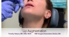 Lip Augmentation
