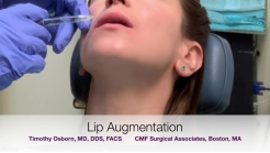 Lip Augmentation