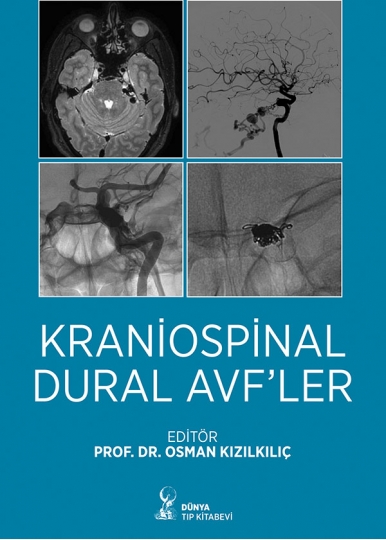 Kraniospinal Dural AVF’ler